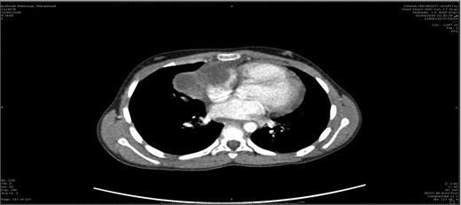 CT scan of the chest.
