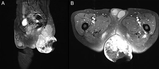 T1WI contrast-enhanced MRI with fat suppression at first visit. (A) Sagittal image. (B) Axial image. Left gluteal region: a 15 cm tumor extending from the gluteus maximus muscle to the subcutaneous tissue with enhancement of irregular margins was observed. A portion of the tumor had disintegrated, and the internal mass was heterogeneous.