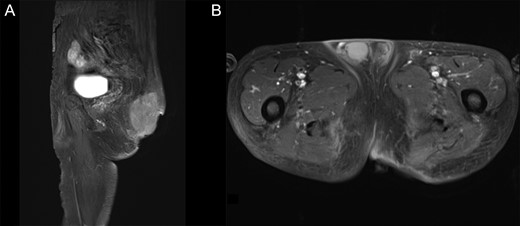Pre-operative T1WI contrast-enhanced MRI with fat suppression. (A) Sagittal image. (B) Axial image. The protruding tumor was resected, and the internal tumors showed no considerable changes in size.