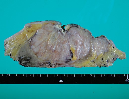 Histopathological finding. Macroscopic image. Area treated with Mohs’ paste was denatured and appeared grayish white.