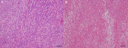 Histopathological finding. (A) Micro-image. Viable residual tumor was observed. Scale bar: 500 μm. (B) Micro-image. Tissue imaging showed necrosis in area treated with Mohs’ paste. Scale bar: 500um.