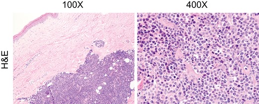 H&E stained tissue sections following excisional biopsy.
