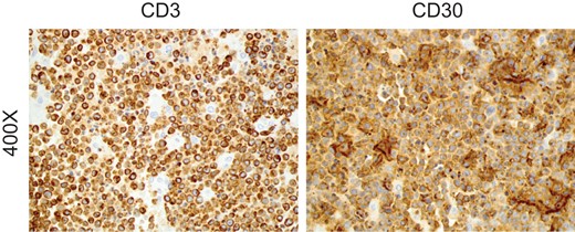 Tissues were stained for CD3 and CD30 expression, affirming a diagnosis of anaplastic large cell lymphoma.