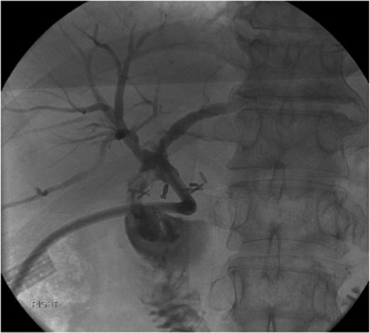 Cholangiogram through the external catheter demonstrating a fistula between the common bile duct, just below the confluence of the right and left hepatic ducts at the terminal end of the catheter, and the duodenum.