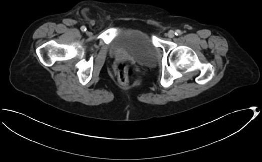 CT scan of the abdomen and pelvis demonstrating acute appendicitis within a femoral hernia.