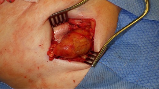 De Garengeot’s hernia – femoral hernia sac containing the vermiform appendix.