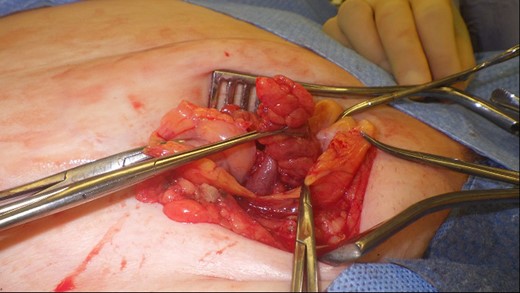 Vermiform appendix freed from hernial sac showing inflammation towards the tip.