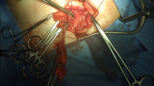 Excised appendix specimen with a slightly longer than usual appendix stump.