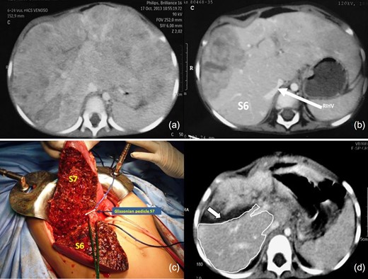 (a) Tumor staging CT (PRETEXT IV), shows all liver sections being invaded by tumor (b) The CT scan post NACT indicates partial tumor response, with persistence of tumor compromising the four sections (POST-TEXT IV). The IRHV is identified (white arrow). No tumor is visible in s6 (c) First stage of ALPPS, the posterior pedicle and its branches were tagged and s7 pedicle clipped (d) FLR on PO15 is outlined in white. The white arrow shows the transection plane.