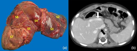(a) Gross pathologic specimen after left trisectionectomy extended to s7. The tumor invades all segments resected, viable tumor was found in the microscopic study. (b) Last CT scan control is shown, with no evidence of recurrence in the liver remnant nor signs of portal hypertension. The white arrow shows the posterior portal branch and s6 pedicle. The black arrow points at the IRHV.