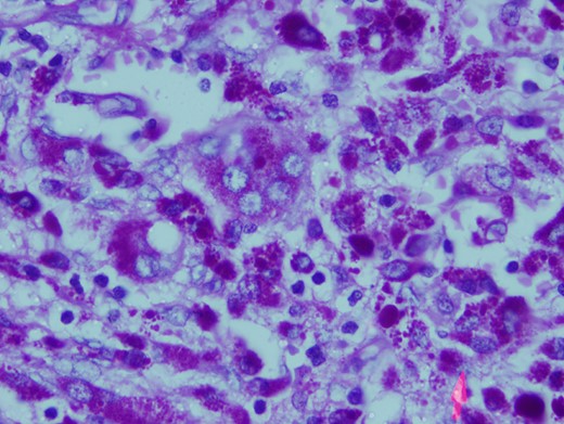 Sheets of polygonal cells with eccentric nuclei, abundant eosinophilic cytoplasm with PAS+ multinucleated cells. High power 20X H&E section.