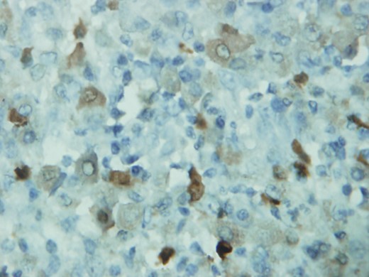 Polygonal tumor cells are positive for S-100 protein (immunohistochemistry).