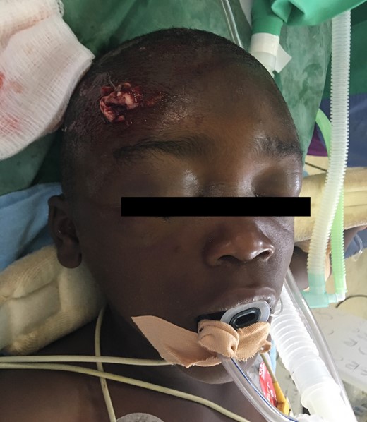 Six-year-old boy presenting with exposed brain matter after sustaining traumatic head injury following road traffic accident.