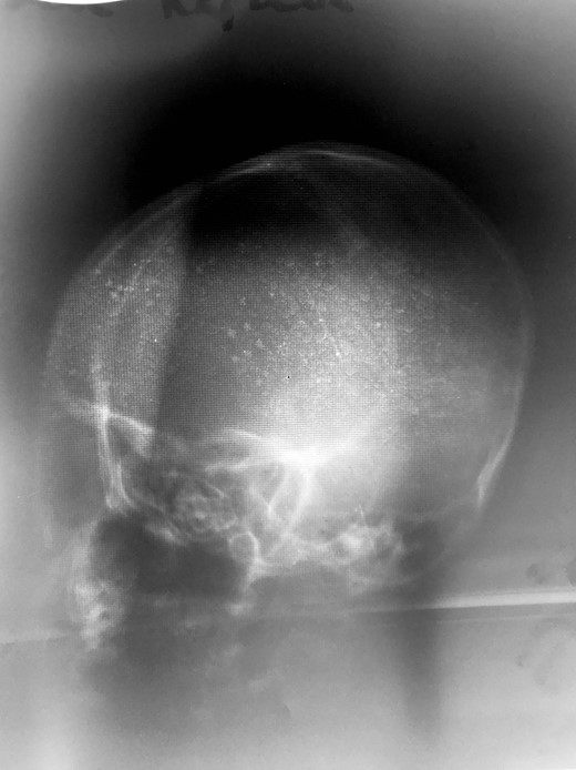 Lateral head X-ray. No other imaging modalities were available or functional at time of patient presentation.