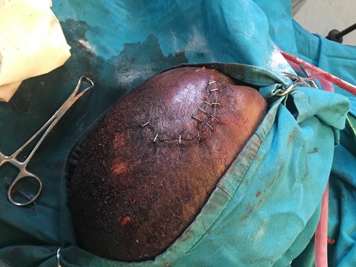 Stapled closure of craniotomy incision and traumatic scalp laceration.