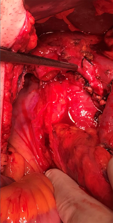 During procedure picture.