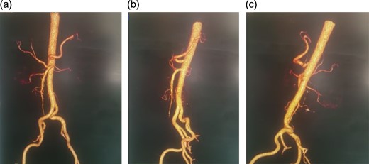 Angiographic CT after procedure.