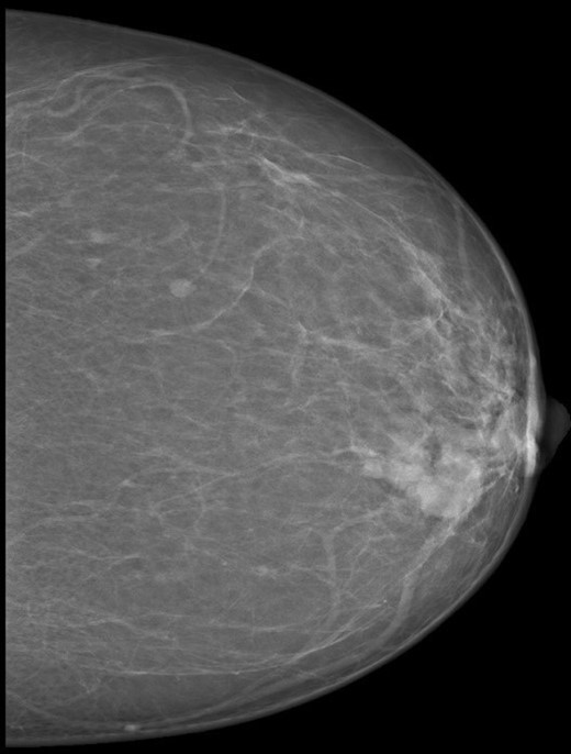 Mammogram picture of left breast showing a lobulated poorly define mass m 3 × 2 × 2.2  cm.