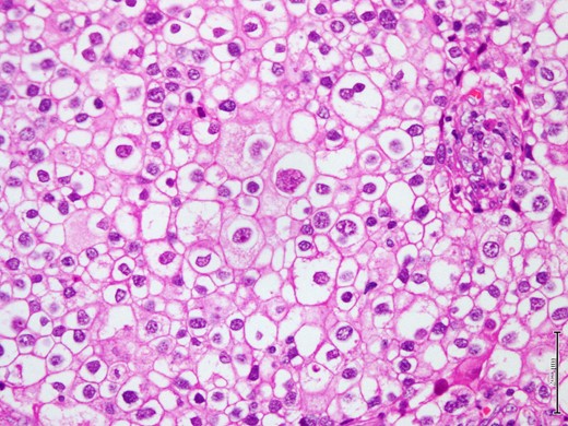Shows microscopic appearance of the tumor composed of large polygonal cells with pleomorphic nuclei and well define nuclear membrane (H&E stain, 40X).