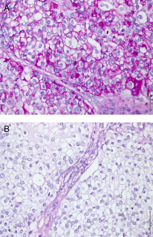 (A) Shows microscopic appearance of the tumor cells in GRCC of breast strongly positive for PAS stain. (B) sensitive for diastase digestion (PASD stain, 20X).