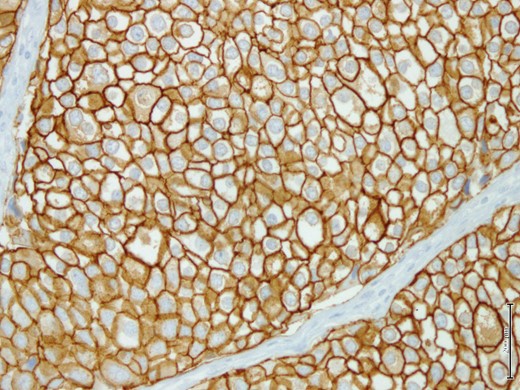 Tumor cells show strong positivity for Her2/neu immunohistochemistry marker.