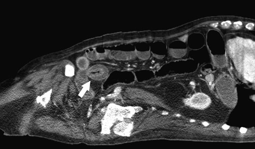 Enterolith-induced small bowel obstruction resembling intussusception (white arrow).