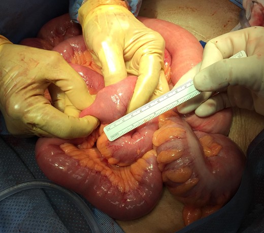 Jejunoileal small bowel obstruction secondary to enterolith without evidence of intussusception.