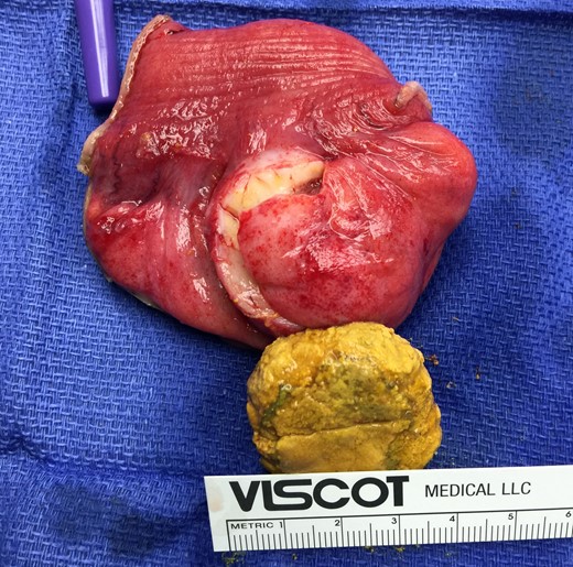 Resected specimen of jejunum with isolated large diverticulum and enterolith.