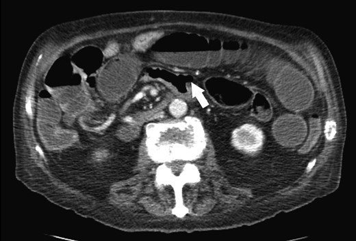 Isolated diverticulum in jejunum (white arrow).