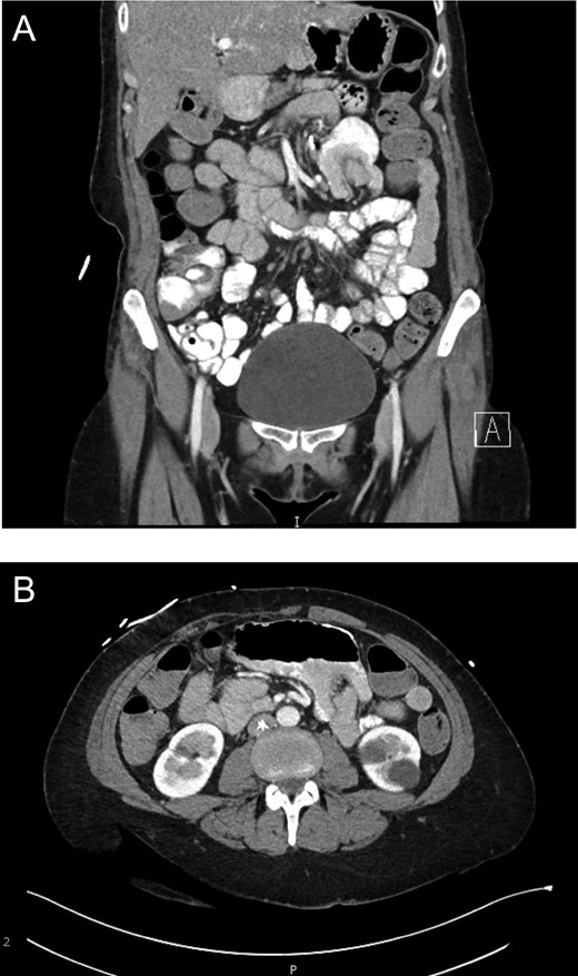 (a) Evidence of intussusception on CT scan (Coronal View). Demonstration of intussusception at the Roux-en-Y enteroenteric anastomosis. (b) Evidence of intussusception on CT scan (Transverse View). Demonstration of intussusception at the Roux-en-Y enteroenteric anastomosis.