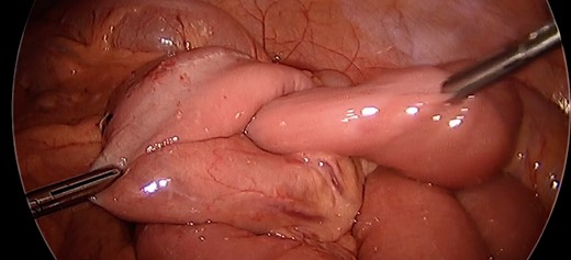 Intussusception. Surgeon manually demonstrating the propensity of the common limb to intussuscept into the anastomosis.