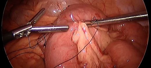 Anchoring bowel to mesenteric root. Nonabsorbable polyfilament suture placement between bowel and nearby mesenteric root limiting bowel mobility toward the anastomotic junction to prevent intussusception.