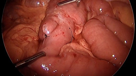 After enteropexy. Demonstration of nonabsorbable suture placement for enteropexy and subsequent inability to intussuscept the common limb into the enteroenteric anastomosis.