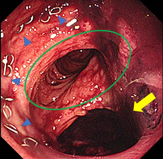 Colonoscopy revealed a true lumen (circle), an anastomotic site (triangle) and a cavity due to suture failure (arrow).