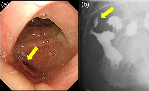 (a) Colonoscopy shows a fistula (arrow). (b) Enema examination shows a cavity (arrow) leading from the fistula.