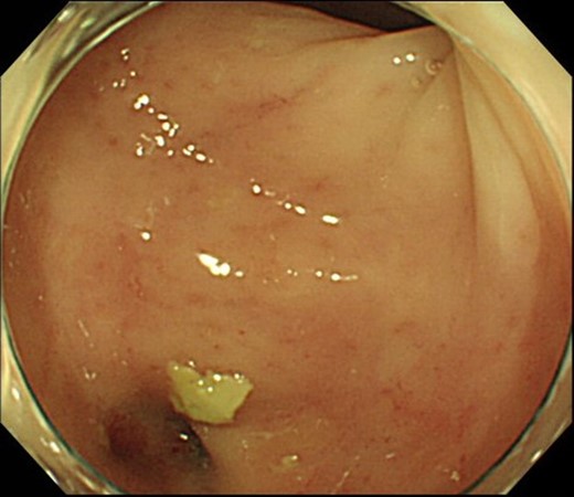 Colonoscopy shows that the suture failure has improved with only a slight depression.