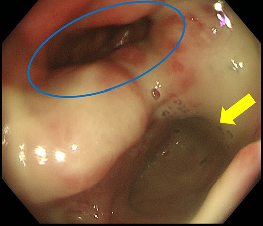 Colonoscopy shows a true lumen (circle) and an abscess cavity (arrow) with drainage of pus.