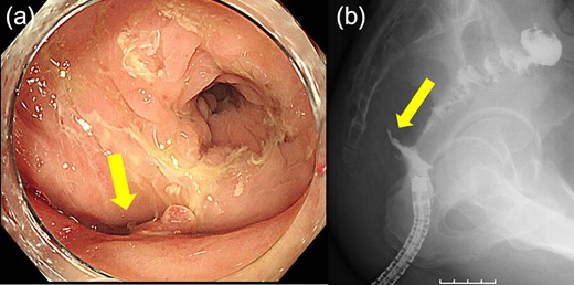 (a) Endoscopic examination shows improvement of the suture failure and fistula formation (arrows). (b) Enema examination shows fistula (arrow).