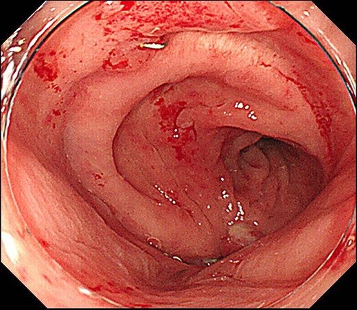 Colonoscopy shows improvement of the suture failure.
