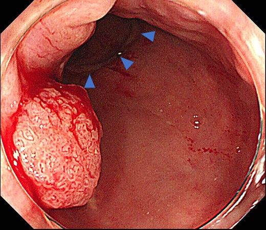 Colonoscopy reveals a polyp on the anal side, about 2 cm from the anastomotic site (triangle).