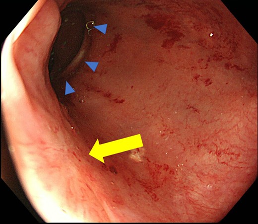 Colonoscopy shows a scar after polypectomy, but no sign of recurrence, and an anastomotic site (triangle).