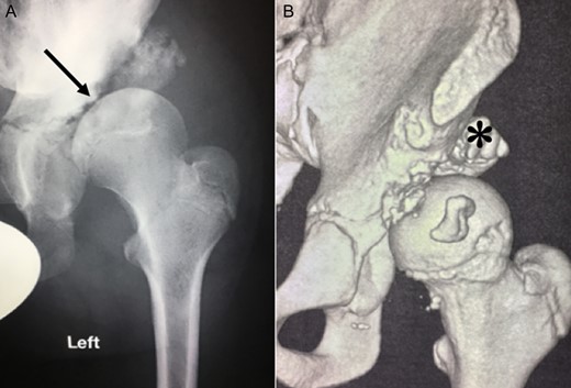 (A + B): (2008) (A) X-ray of the left hip demonstrating subluxation of the femoral head which is destroying the edge of the acetabulum (arrow) like a mortar. (B) 3-D reconstruction of the hip showing bony debris of the acetabulum edge forming a secondary acetabulum (asterisk) trying to cover the femoral head.