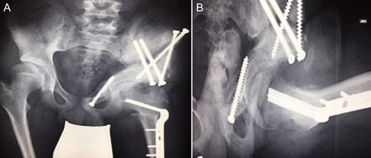 (A + B): (2008) (A) Hip reconstruction with open reduction, Tönnis triple pelvic osteotomy and shortening rotational varus osteotomy of the left femur demonstrating correct deep reposition in ap view. (B) Lauenstein view shows that the acetabular congruency over the femoral head is restored.