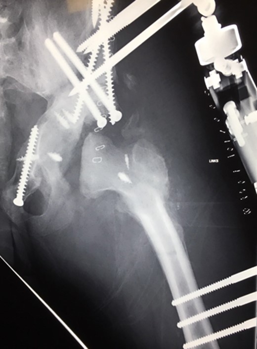 (2008) Despite reconstruction the femoral head subluxated and rapidly lost congruency. An open reduction and capsular reconstruction with trevira tube, removal of the femoral plate and temporary fixation with an external fixator with movable hip mechanism for flexion of the joint (Orthofix MonoRail) was performed.