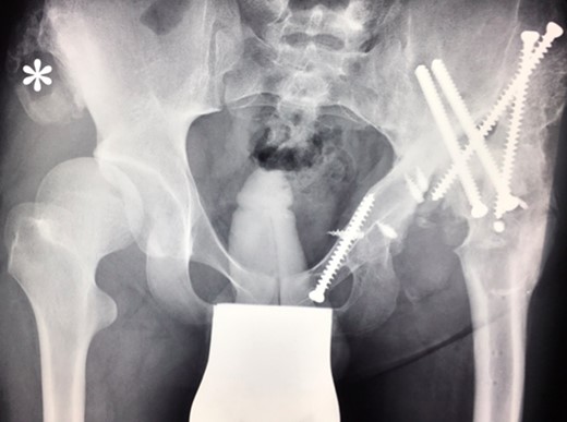 (2009) Despite conservative treatment the right hip subluxates. There is new bone formation at the proximal os ileum (asterisk) without trauma. The acetabulum is still congruent and decision was made to restore the hip joint by surgery.