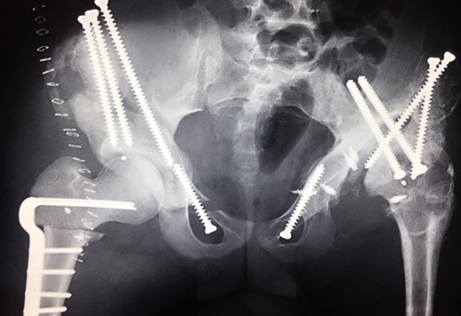 (2009) Operative reconstruction of the right hip with open reduction, capsular reconstruction with trevira tube augmentation, triple osteotomy and DVO of the proximal femur to prevent destructive degeneration was performed.