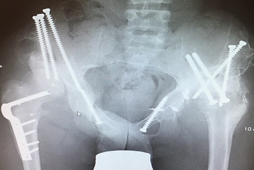 (2010) Hip dislocation of the right side despite reconstruction.