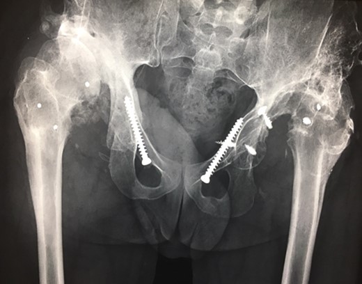 (2013) Further destruction of any bony congruency at the left side, dislocation on the right side.