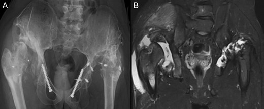 (A + B): (2019) (A) x ray of the pelvis after a 10 year follow up. The right head further migrated und subluxated and femoral head necrosis is visible, new bone formation at the ileum stabilizing the joint. At the left side high dislocation of the hip with fully necrosis of the head and ankylosis of the hip joint. (B) MRI showing hip effusion around the joint which is painless.