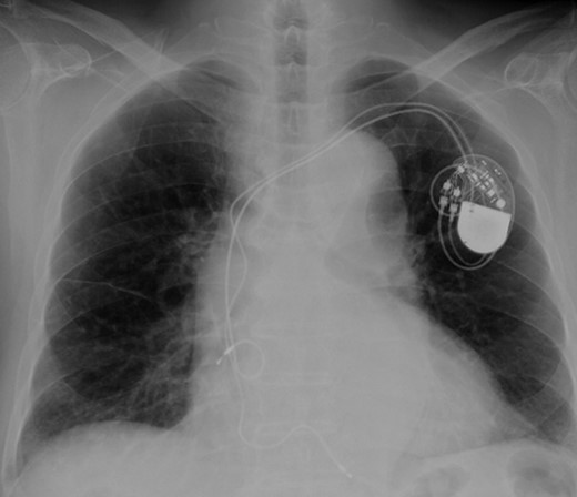 Preoperative chest X-ray.